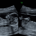 Three Attempts and Two Miracles