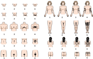 Polycystic ovary